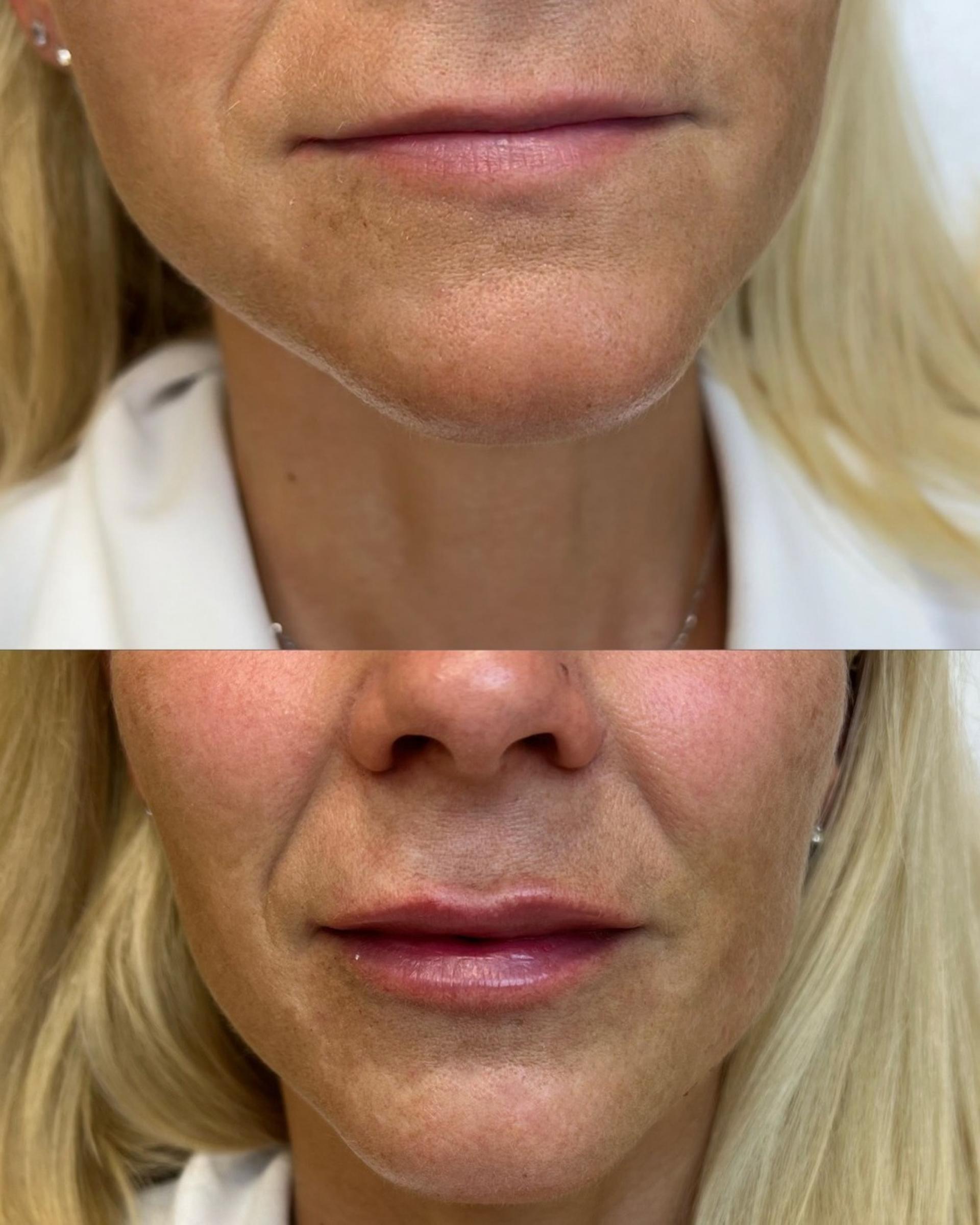 Efekt zvět&scaron;en&iacute; rtů