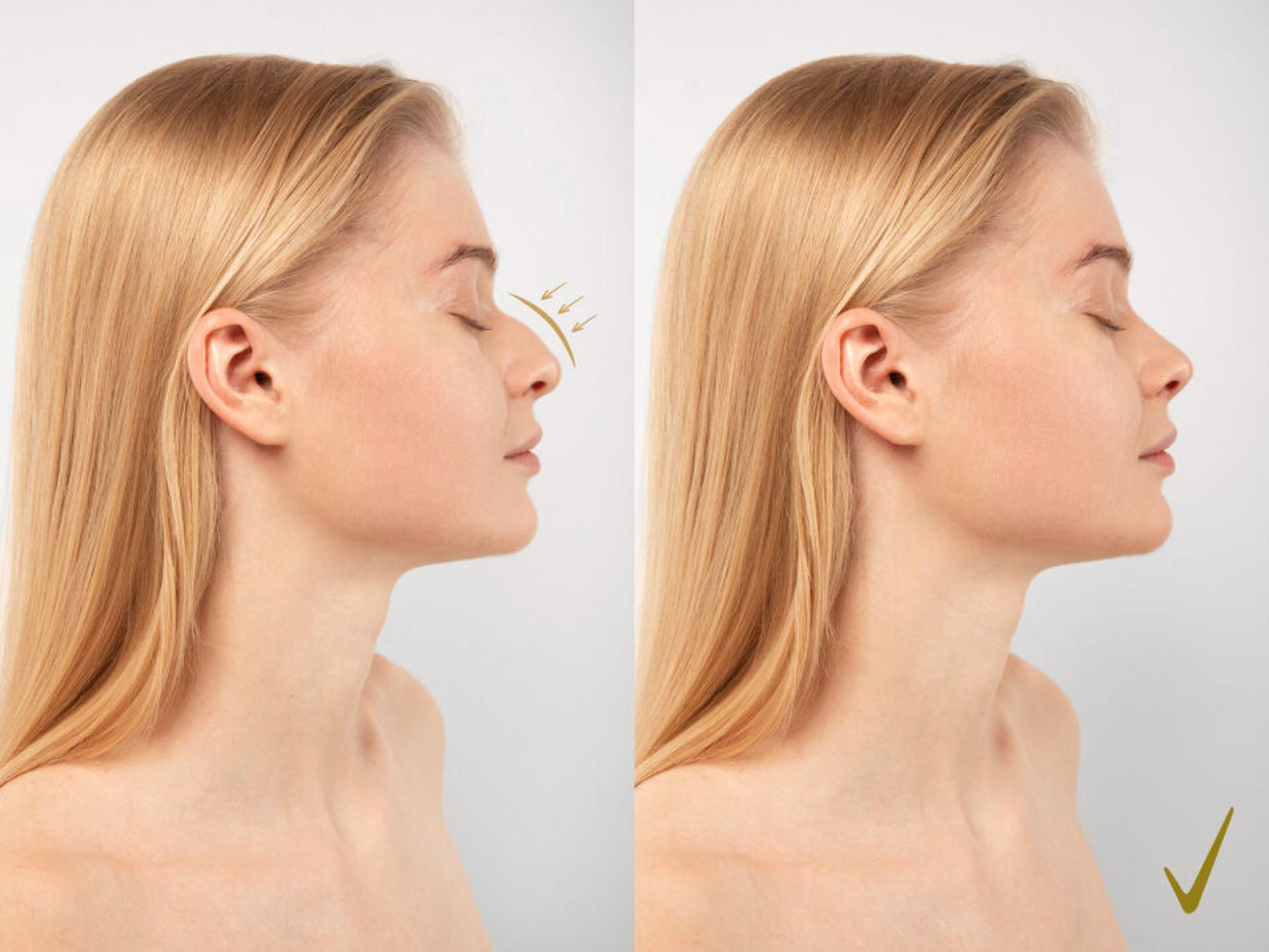 Rhinoplastika