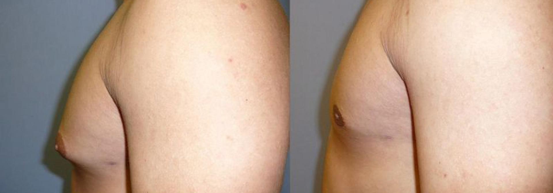 Gynekomastie před a po