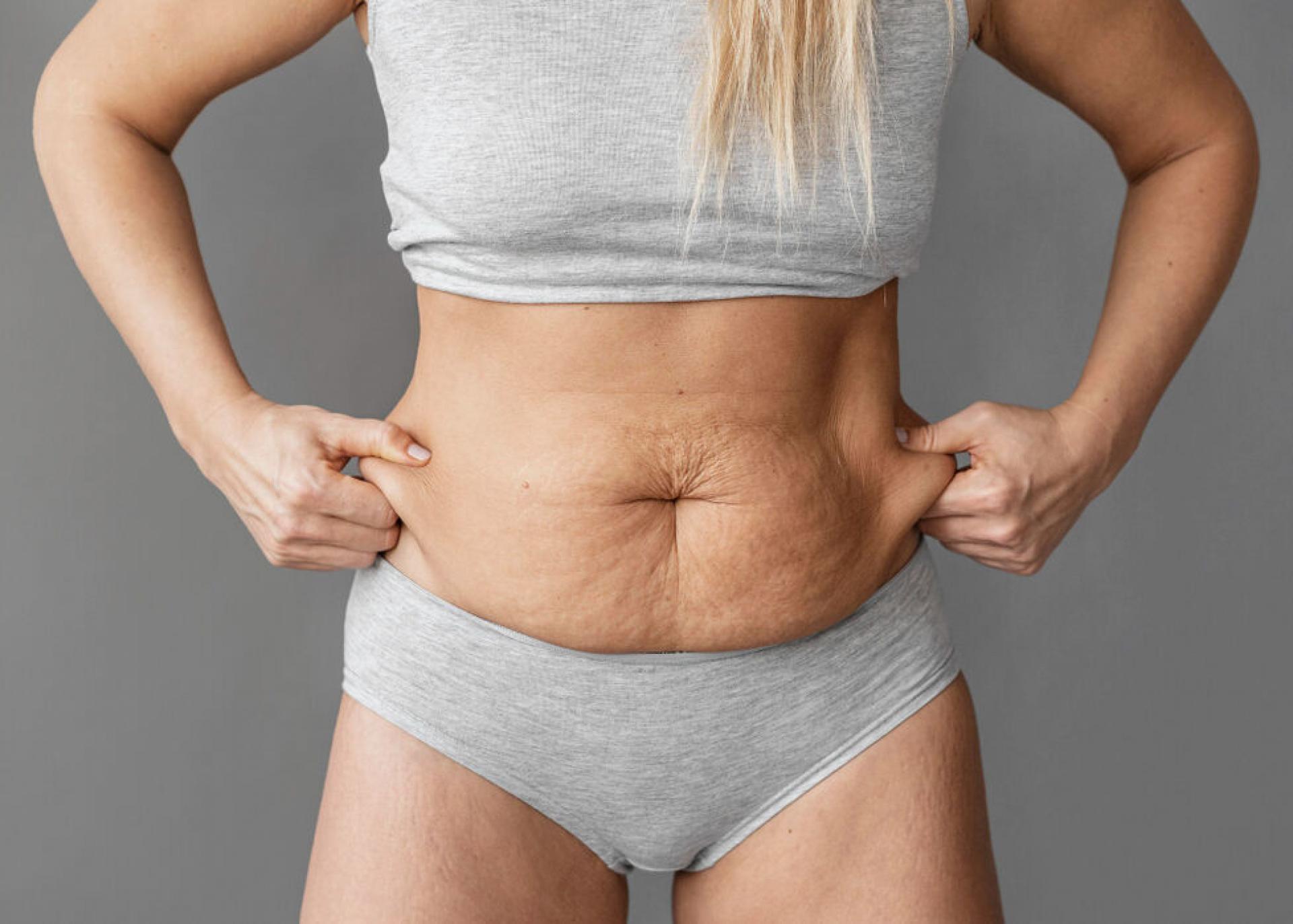 Abdominoplastika